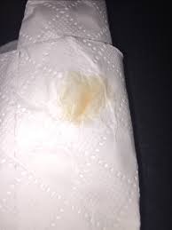My mucus plug fell out, and this is what it looks like.what is the mucus plugwhat is the mucus plug formucus plugwhat does the mucus plug look likehow does. Is It Normal To Have Pink Spotting In Early Pregnancy