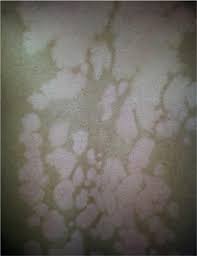 Image result for Postinflammatory Hypopigmentation