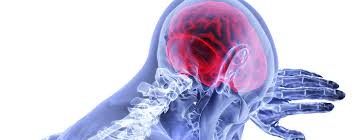 Brain Injury - Goodman Halioua LLP