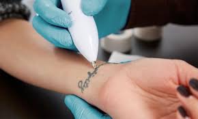 The laser tattoo removal price increases by appx. Three Sessions Of Laser Tattoo Removal On Small Medium Or Large Area At Al Biraa Clinic Discountsales Ae Discount Sales Special Offers And Deals In Dubai Uae