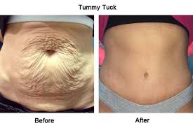 Pin On Plastic Surgery Before And After