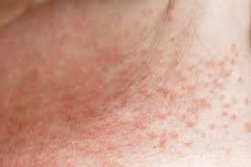 Image result for sweat rash on back
