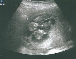 Sep 15, 2020 · 36 weeks: Fraternal Twins At 13 Weeks