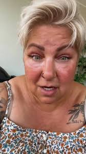 #stitch with @Dr. Z 🧠 Neurosurgery yes it worked for meeeee #daithpiercing  #migraines #ears