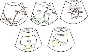Image result for PECARN Pediatric Intra-Abdominal Injury Algorithm