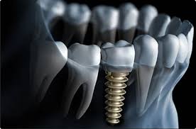 Computer Guided Dental Implant Surgery in Ahmedabad | US Dental