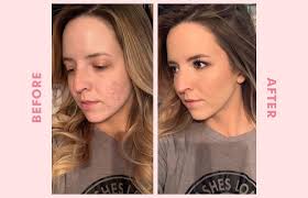 how to cover acne with makeup a makeup