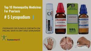 Pin By Nina On Homeo Psoriasis Cure Homeopathy Treatment Homeopathy