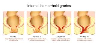 Image result for hemorrhoids