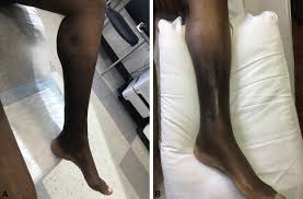 Image result for Lipodermatosclerosis