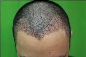 Asian man hair loss treatment one year post op result hair transplant restoration by dr diep. What Is The Downtime After Fue Hair Transplant