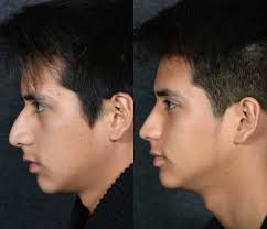 Cosmetic Surgery Procedures Including The Rhinoplasty Are More Common For British Asian Men Than You Might S Cosmetic Surgery Rhinoplasty Rhinoplasty Nose Jobs