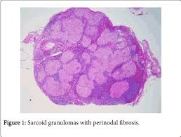 Maybe you would like to learn more about one of these? Infective Germination Granulomatous Inflammation Lymph Node
