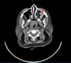 Image result for Progressive Bulbar Paralysis