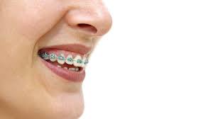 Ein facharzt entscheidet darüber, ob die zahnregulierung durch eine. á… Feste Zahnspange Merkmale Funktion Und Pflege