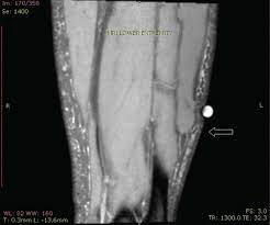 Fascial Hernia Definition Causes Symptoms Diagnosis Treatment