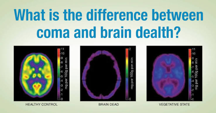 What is the Difference Between a Coma and Brain Death? | LifeSource