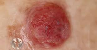 Amelanotic melanoma 3mm image