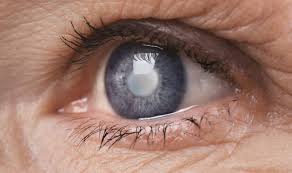 Grauer Star Symptome Behandlung Netdoktor At