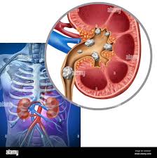 Image result for Calcium Nephrolithiasis
