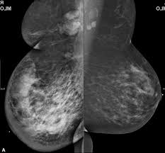 Image result for Inflammatory breast cancer