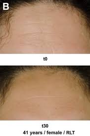 Maybe you would like to learn more about one of these? How Often Should I Use Red Light Therapy Red Light Therapy 101