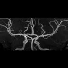 We did not find results for: Azygos Anterior Cerebral Artery Radiology Case Radiopaedia Org
