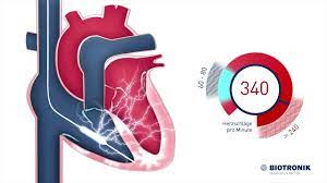Maybe you would like to learn more about one of these? Defibrillator Icd Therapie Animation Medizin Youtube