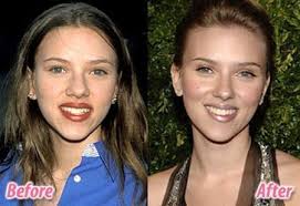 Scarlett ingrid johansson was born on november 22, 1984 in manhattan, new york city, new york. Scarlett Johansson Before And After Nose Job Rhinoplasty Botoxbeforeandafter Plastische Chirurgie Neuscorrectie Chirurgie