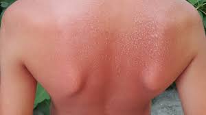 Image result for Sunburn
