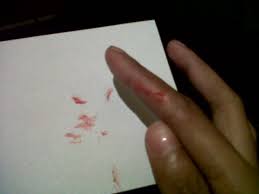 Meskipun kebanyakan tidak berbahaya, benjolan di tangan bisa menimbulkan rasa tidak nyaman saat beraktivitas, terutama bila terjadi pada tangan yang dominan. Firdhaaaaaaaaa On Twitter Engga Ada Tisu Darah Nya Di Lap Pake Kertas E Æª Uhwoo Atit Wkwkw Lebay D Http T Co Zk4towff