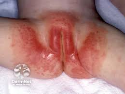 Image result for dermatitis contacta children