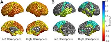 Schizophrenia is a mental disorder characterized by continuous or relapsing episodes of psychosis. Cortical Brain Abnormalities In 4474 Individuals With Schizophrenia And 5098 Control Subjects Via The Enhancing Neuro Imaging Genetics Through Meta Analysis Enigma Consortium Biological Psychiatry