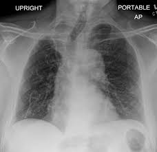 Image result for Atelectasis