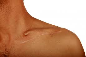 Having pain under or near your shoulder blade—the triangular bone that forms the back of your shoulder—may limit arm movements and interfere with daily activities. Lump On Collarbone Symptoms Causes And Treatment