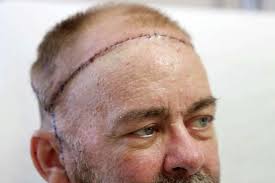 Skull, scalp transplant enables patient to get life-saving organs