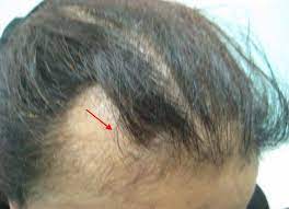 Scalp fungus causes hair loss in patches because it affects the hair fibers. Scalp Biopsy And Diagnosis Of Common Hair Loss Problems Intechopen