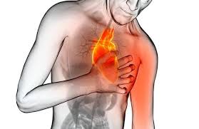 Image result for Angina Pectoris