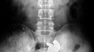 See more production information about this title on imdbpro. X Ray Showing A Buzz Lightyear Action Figure Imgur