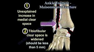 The external rotation force to the ankle with the foot in either pronation or supination was frequently reported. Ankle Fracture Maisonneuve Fracture Everything You Need To Know Dr Nabil Ebraheim Youtube