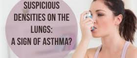 Apical=apex, tip or top of an object My Xray Result Suggest For Apico Lordotic View Other Respiratory Disorders Discussions Body Health Conditions Center Steadyhealth Com