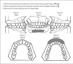 Figure 1 From Piezocision Accelerating Orthodontic Tooth