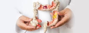 Colon cancer (also known as colorectal cancer) is a malignant tumor, arising from the inner wall of the large intestine. Advanced Surgical Associates Colorectal Surgery I