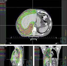 radiation can shrink large, painful tumors for patients with any type of mesothelioma. Radiotherapy For The Treatment Of Malignant Pleural Mesothelioma The Lancet Oncology