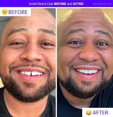 45 Smile Direct Club Before After Photos Transformation Pics Smiledirectclub Smileclubdirect In 2020 Smile Direct Smiledirectclub Smile Club Direct