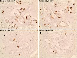 Some combinations of minor prostate cancer (e.g. Ki67 Is An Independent Predictor Of Recurrence In The Largest Randomized Trial Of 3 Radiation Fractionation Schedules In Localized Prostate Cancer International Journal Of Radiation Oncology Biology Physics