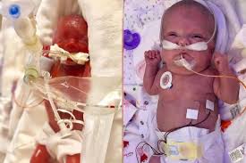 Some babies need less than a. Photos Show Incredible Transformation Of Premature Baby Born At 23 Weeks The Independent The Independent