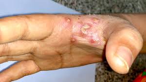 Image result for scabies human bites