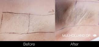 Full body laser hair removal cost in toronto vs medspa laser clinic is very. Laser Hair Removal Procedure In Toronto Spamedica