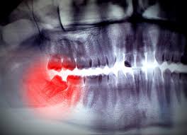 Although the teeth at the front of your mouth often get the most attention, it pays to give attention to your molars—particularly the third set of molars at the very back. Symptoms That May Indicate You Need Your Wisdom Teeth Removed St John Health